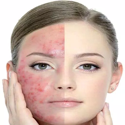Get Rid of Acne  (Guide) 스크린샷 2